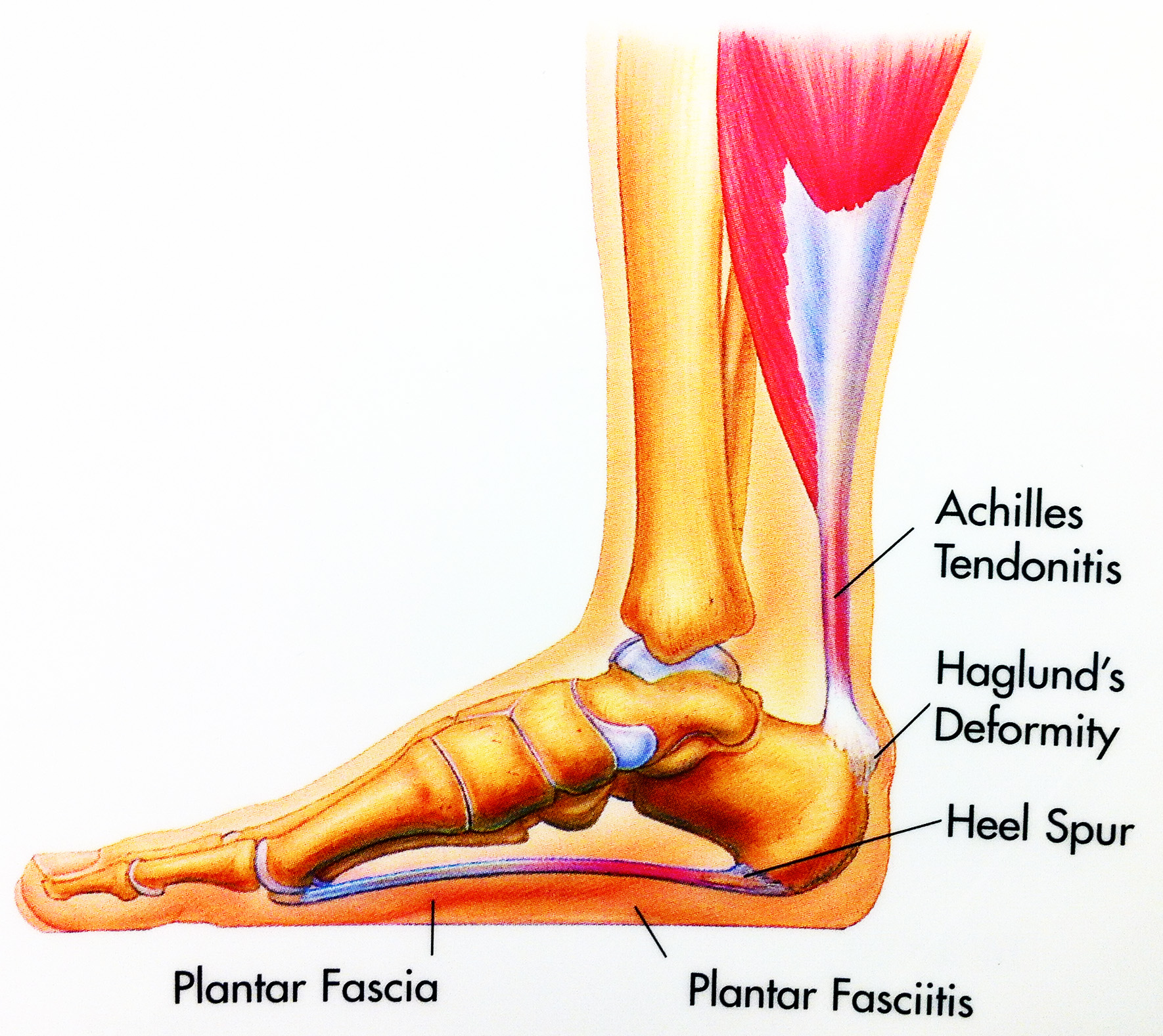 symptoms of bone spurs in feet