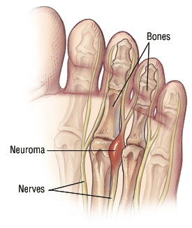 Morton's Neuroma: Causes, Symptoms & Treatment