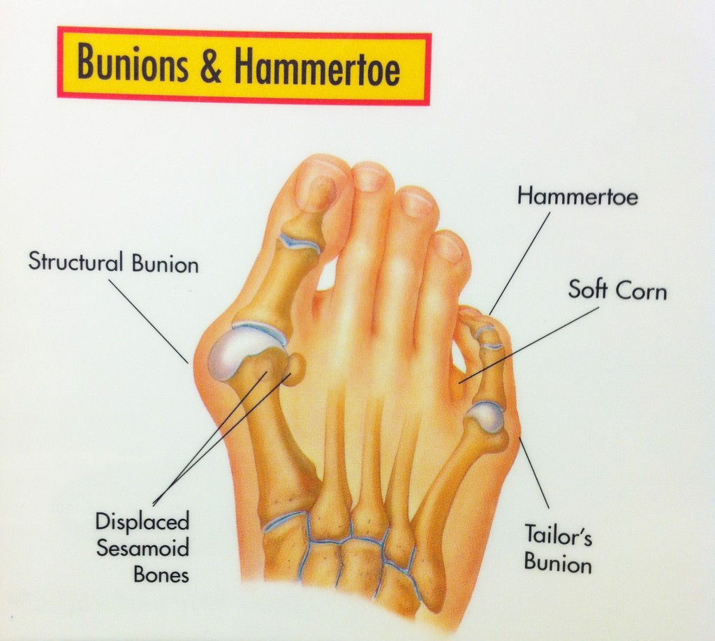 Foot Bunion Joint at Gordon Smith blog