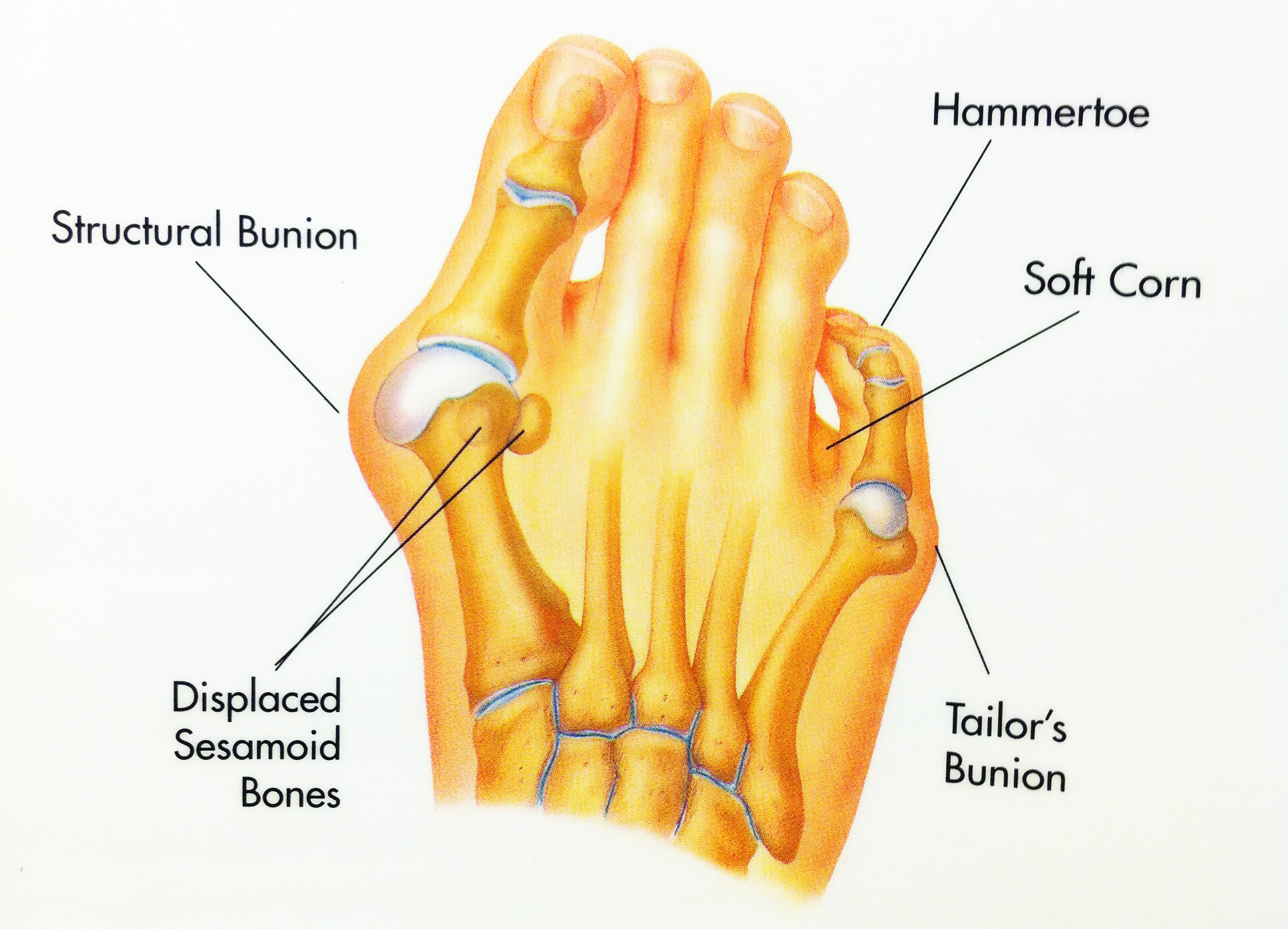 Hammertoes  Foot & Ankle Doctors, Inc.